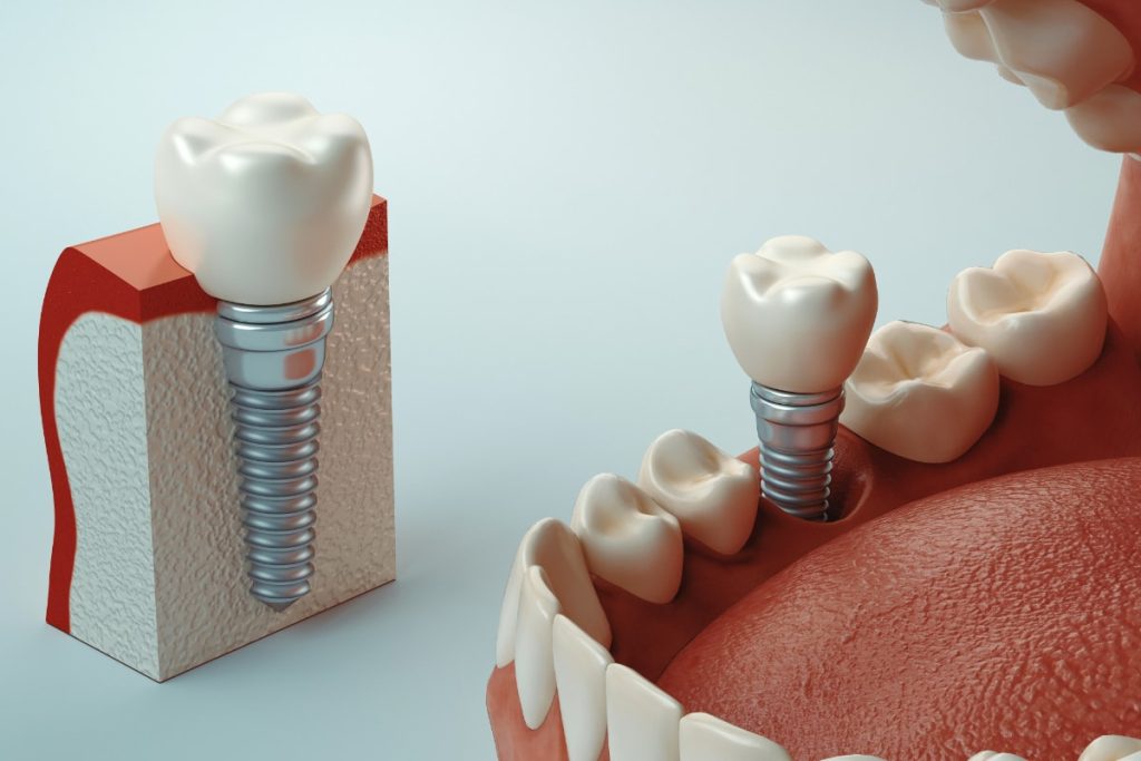 Implantologia Clinica Dental Dra De Las Heras